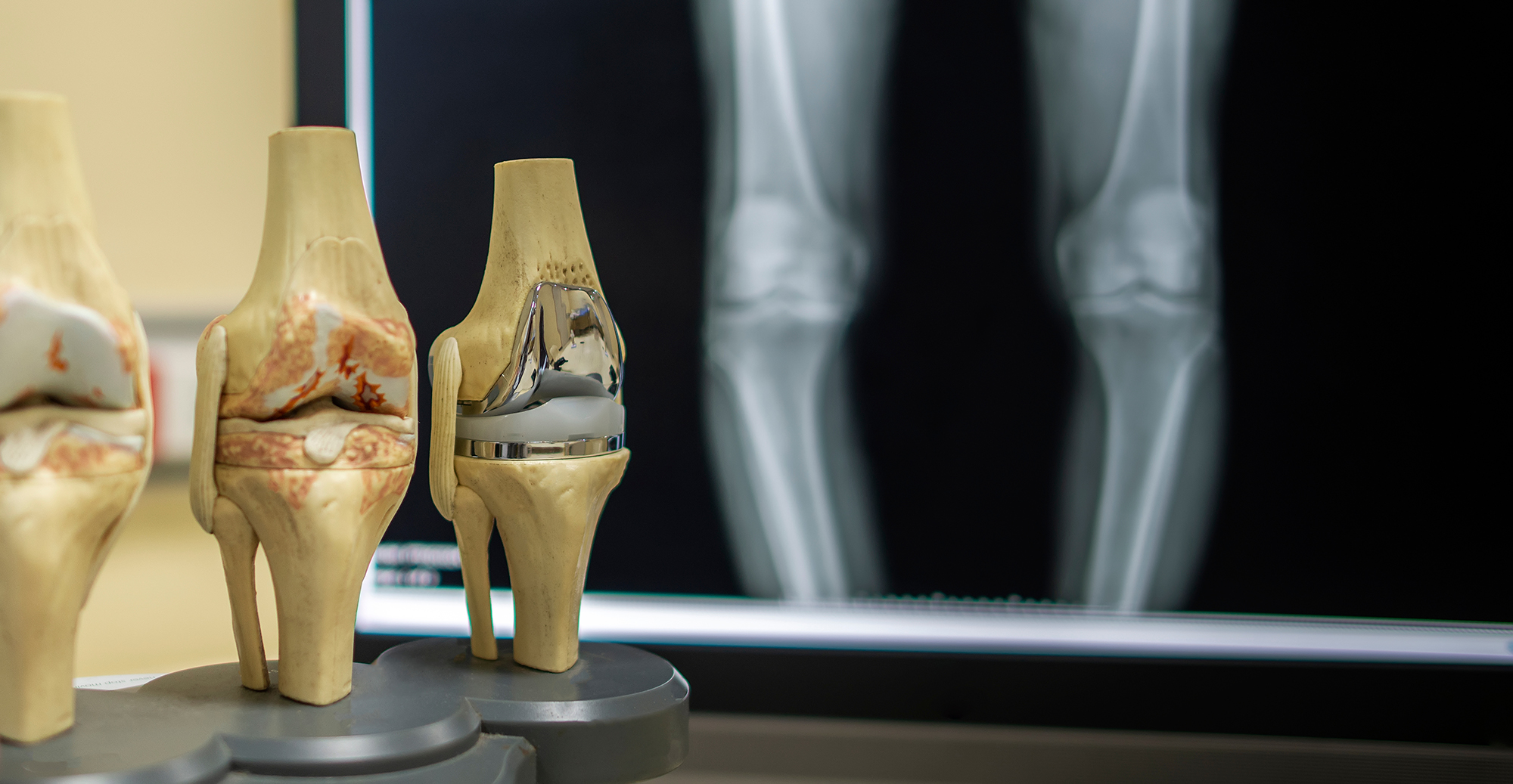 人工膝関節置換術の問題点